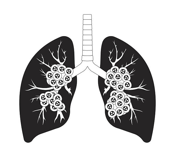 Human lungs affected by late-stage cancer outline illustration