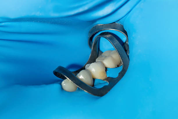 istock Cervical composite filling procedure with rubber dam isolation 2254834422