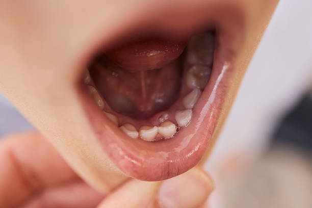 Close up of woman with malocclusion of teeth. Overbite.