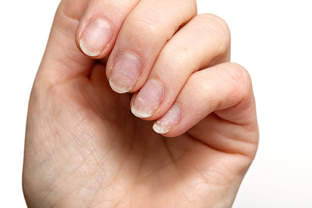 istock Damaged fingernails after gel polish removal 2260909123