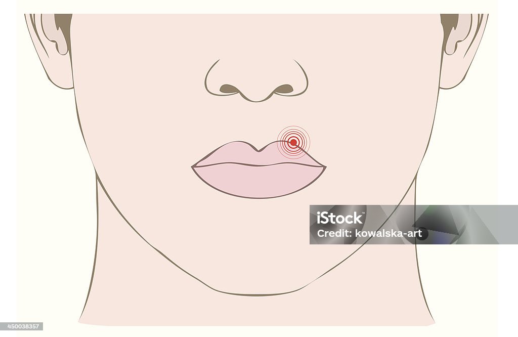 Médecine illustration, de maladie virus de l'herpès virus sur la bouche - clipart vectoriel de Virus de l'herpès libre de droits