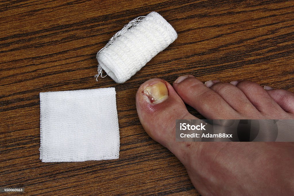 Treatment after the removal of ingrown toenail Ingrown toenail disease blood wound infection bacteria  finger  skin scab pus  toe liquid whitlow felon treatment swelling on a brown table background Adhesive Bandage Stock Photo