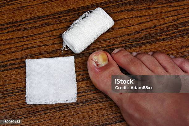 Treatment After The Removal Of Ingrown Toenail Stock Photo - Download Image Now - Adhesive Bandage, Bacterium, Bandage