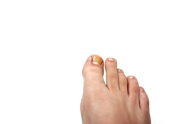 Toenail Pus Stock Photos, Pictures & Royalty-Free Images - iStock Toenail Pus Stock Photos, Pictures & Royalty-Free Images - iStock