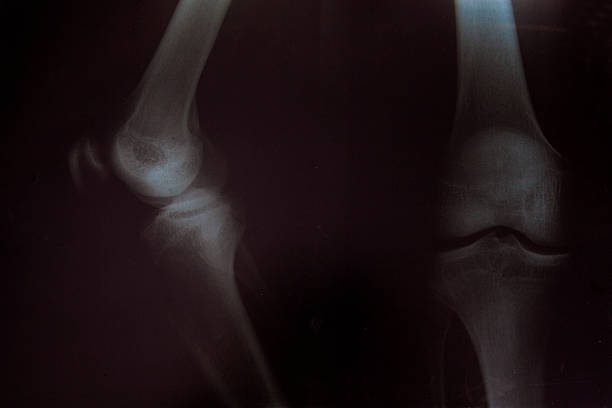 genoux x-ray - x ray human knee orthopedic equipment human bone photos et images de collection