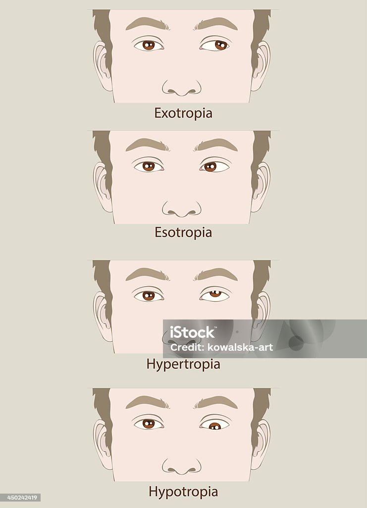 欠陥 Esotropia 、Exotropia 、Hypertropia 、Hypotropia - イラストレーションのロイヤリティフリーベクトルアート