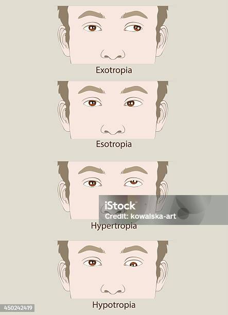 Wada Esotropia Exotropia Hypertropia Hypotropia - Stockowe grafiki wektorowe i więcej obrazów Anatomia człowieka - Anatomia człowieka, Badanie lekarskie, Choroba