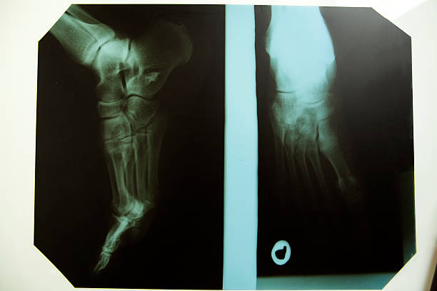 große x-ray in beiden positionen - bending human foot ankle x ray image stock-fotos und bilder