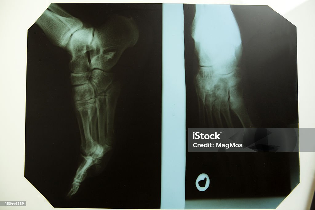 Foot x-ray in two positions Photo taken in two positions Arthritis Stock Photo