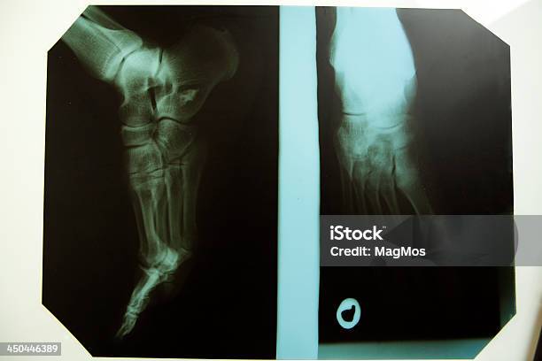 Foot Xray In Two Positions Stock Photo - Download Image Now - Arthritis, X-ray Image, Ankle