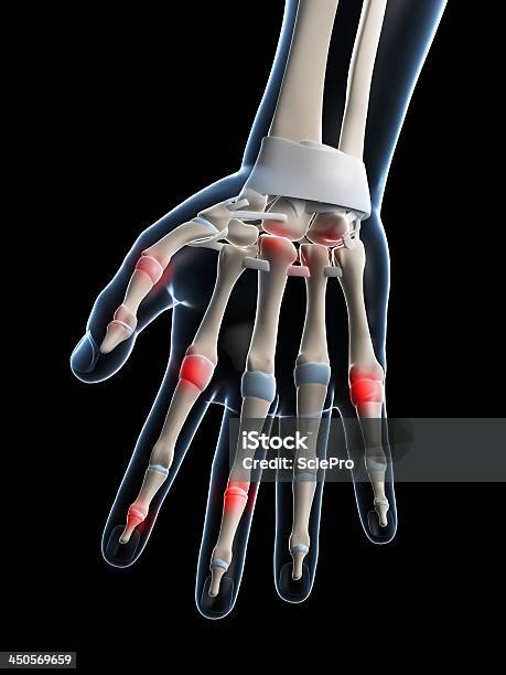 Dolor De Las Articulaciones De Los Dedos Foto de stock y más banco de imágenes de Articulación - Articulación, Articulación humana, Artritis