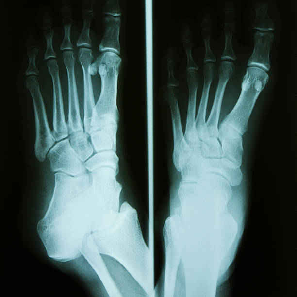 pé de raio-x. - bending human foot ankle x ray image - fotografias e filmes do acervo