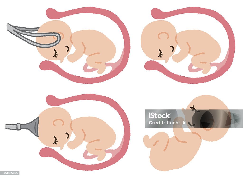 Forceps And Pulls Stock Illustration - Download Image Now - Forceps,  Childbirth, Baby - Human Age - iStock