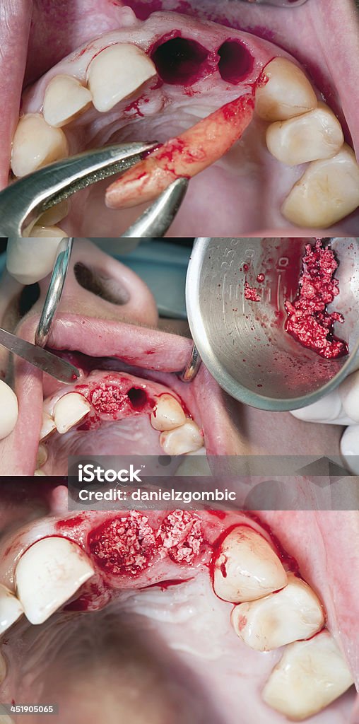 Bone Augmentation after Teeth Extraction Process of bone augmentation after teeth extraction. Selective focus. Absence Stock Photo