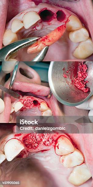 Bone Augmentation After Teeth Extraction Stock Photo - Download Image Now - Absence, Activity, Bacterium