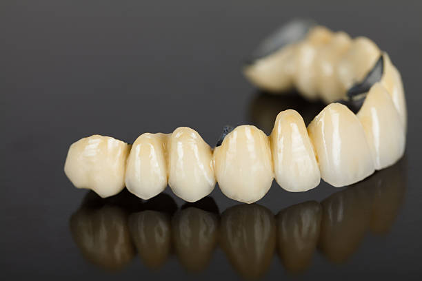 istock Porcelain teeth - dental bridge 452106383