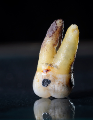 plumbed molar tooth