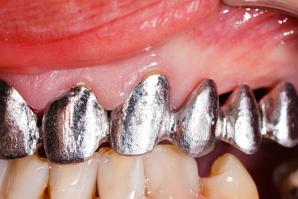 istock Metal Basis Dental Bridge 452144327