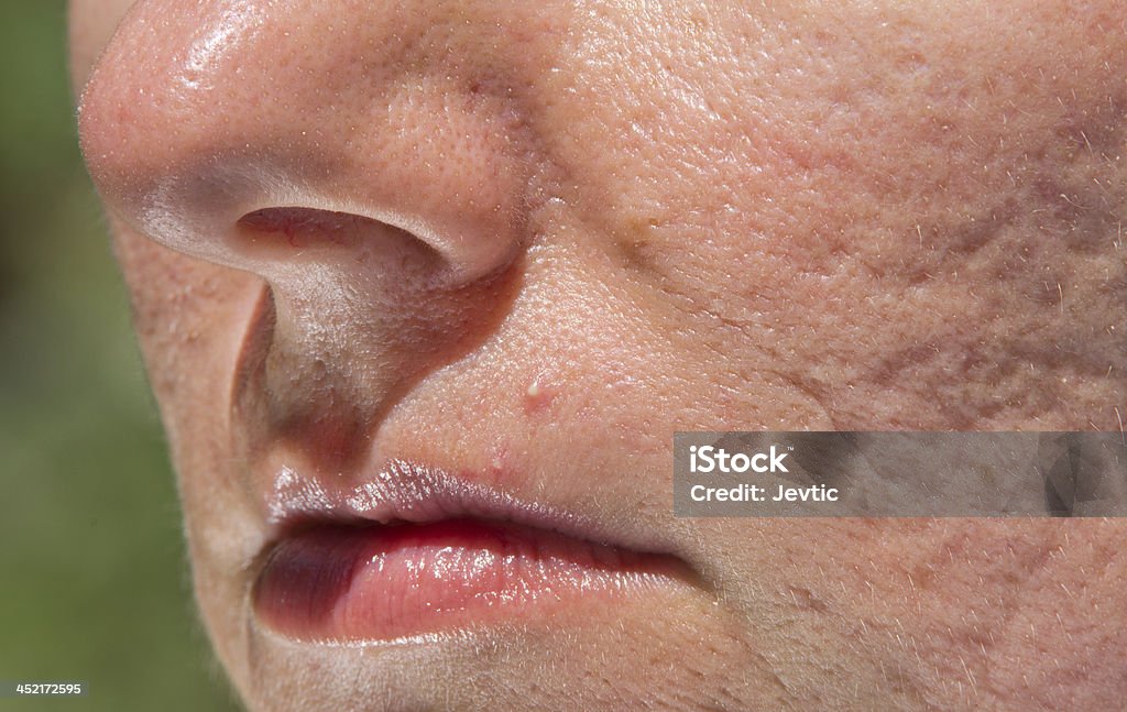 Brufolo e acne cicatrici - Foto stock royalty-free di Acne