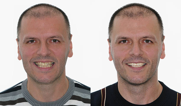 antes de & después de sonrisa diseño - hombre feo fotografías e imágenes de stock