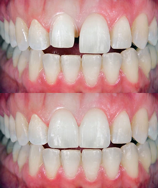 Before & After Dental Veneer stock photo