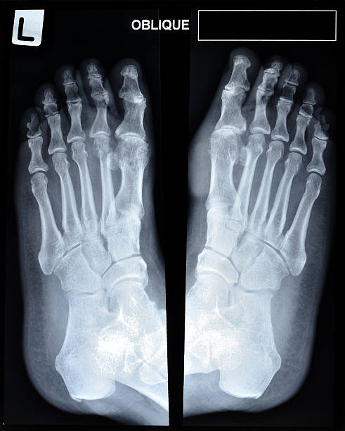 istock an x-ray of mature man's feet. 453170413
