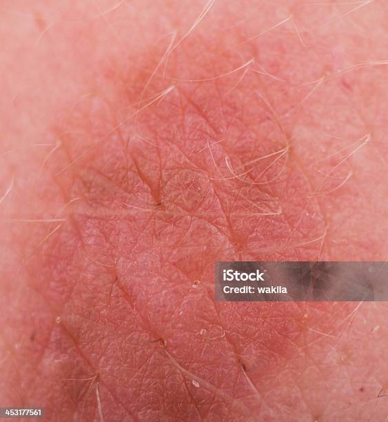 Leberfleck Makroaufnahme - Fotografias de stock e mais imagens de Adulto - Adulto, Cabelo Humano, Capilar - Vaso sanguíneo