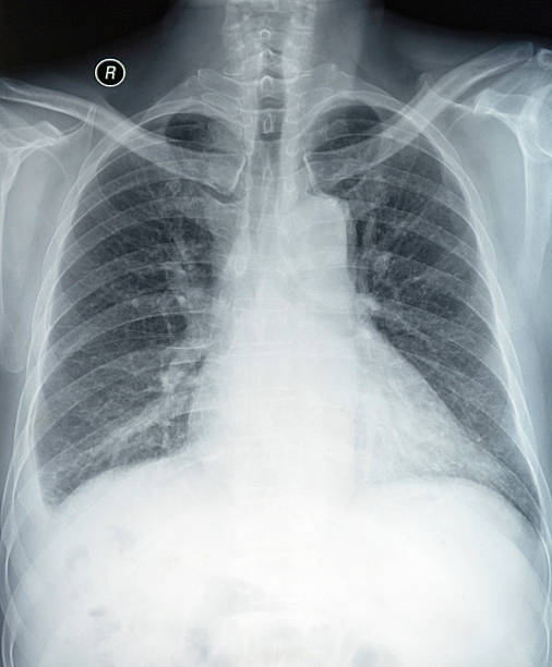 istock x-ray of a human thorax 453260373