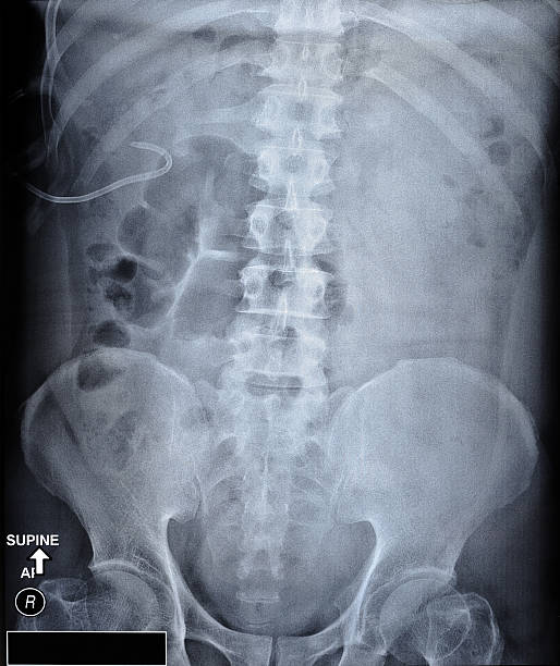 X-ray comprimidos de cálculos renais com stent ureteral - fotografia de stock