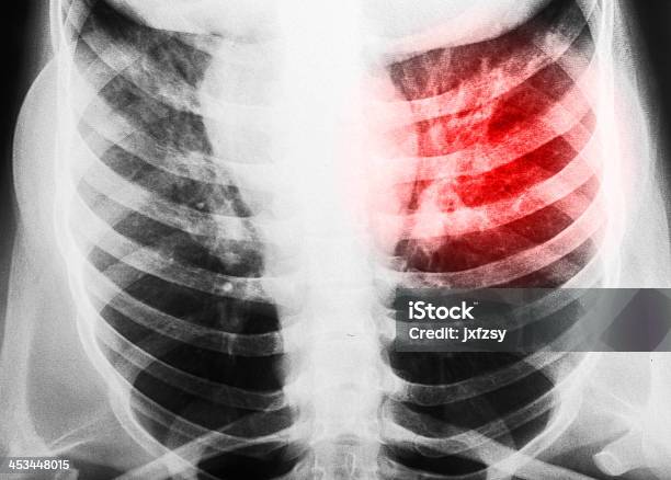 Prześwietlenie Klatki Piersiowej - zdjęcia stockowe i więcej obrazów Anatomia człowieka - Anatomia człowieka, Badanie lekarskie, Bez koszulki