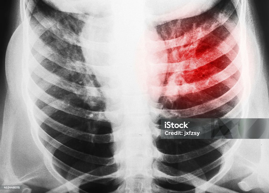 Raios x do peito - Royalty-free Anatomia Foto de stock