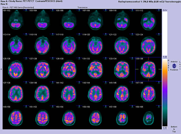 PET-CT axial scan of the brain These are computer generated images, fusing PET (positron emission tomography) with CT (computed tomography) scan of the brain (in axial or horizontal cuts). It consists of injecting a radioactive analogue of glucose, FDG (fluorodeoxyglucose) into the bloodstream; the three-dimensional images of tracer concentration within the brain are then constructed by computer analysis. The more metabolically active areas will retain more FDG, and consequently retain more radiation (orange color). It is an important tool for detecting malignant tumor like metastasis mainly in other parts of the body. In the brain, it also has been used to detect areas of the brain that generate seizures.  pet scan photos stock pictures, royalty-free photos & images