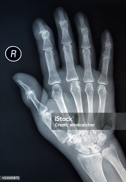 Xray Mão Humana - Fotografias de stock e mais imagens de Acidentados - Acidentados, Anatomia, Articulação - Parte do corpo