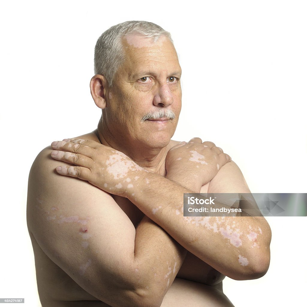 Reifer Mann mit vitiligo - Lizenzfrei Arme verschränkt Stock-Foto