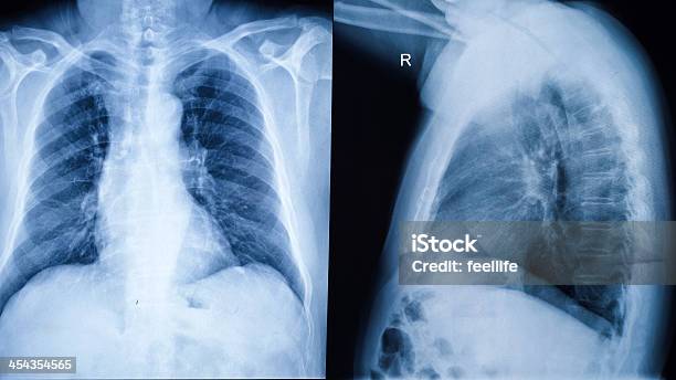 Imagem De Raios X Do Peito Humano - Fotografias de stock e mais imagens de Imagem de raios X - Imagem de raios X, Constipação e Gripe, Pneumonia