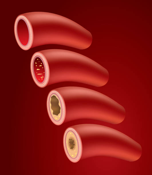 miażdżyca tętnic - blood cell anemia cell structure red blood cell stock illustrations