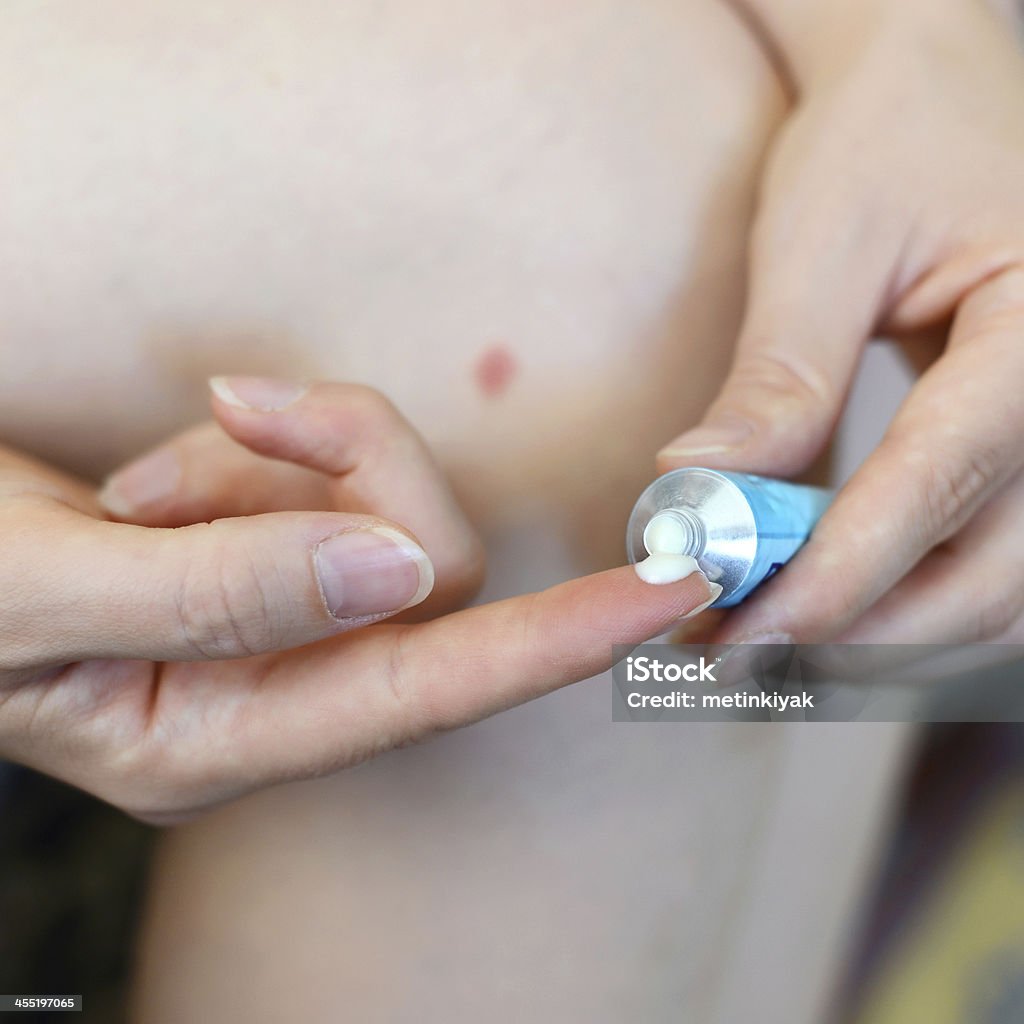Woman applying ointment on mosquito bite Woman making creme on Mosquito bites Ointment Stock Photo