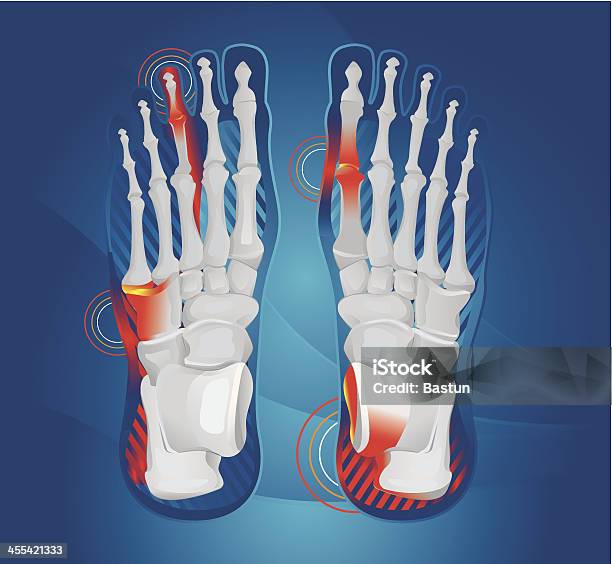 Foot Bóle - Stockowe grafiki wektorowe i więcej obrazów Anatomia człowieka - Anatomia człowieka, Artretyzm, Badanie lekarskie