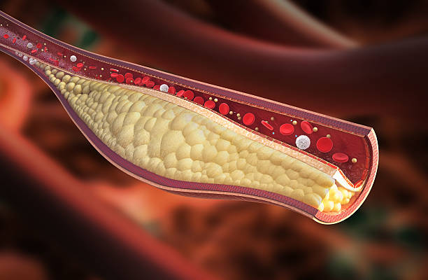 istock Vein - stable atherosclerotic plaque 455640223