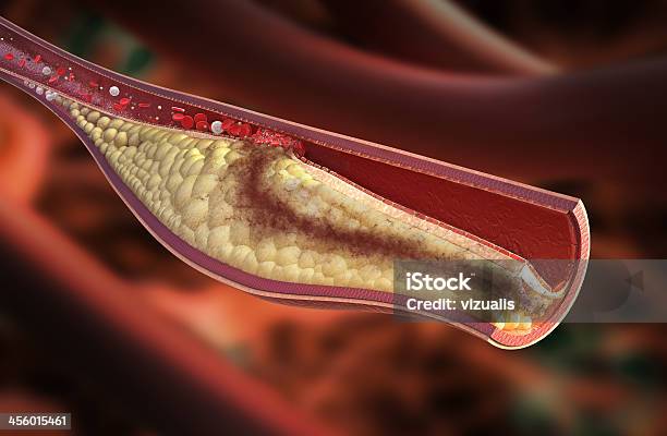 Photo libre de droit de Veineatherosclerotic Plaque Développement banque d'images et plus d'images libres de droit de Rupture de plaque - Rupture de plaque, Indécision, Occlusion