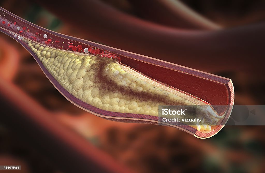 정맥-atherosclerotic 상패 개발 - 로열티 프리 플라크 파열 스톡 사진