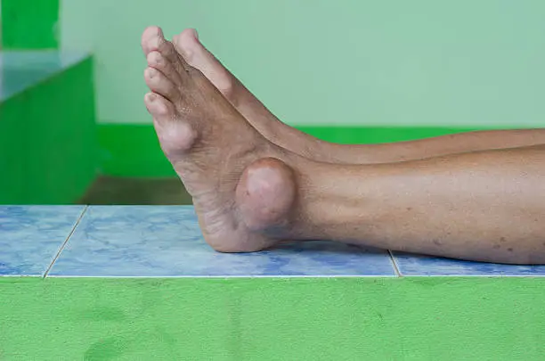 foot of gout patient