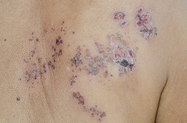 Herpes zoster Herpes zoster shingles rash stock pictures, royalty-free photos & images