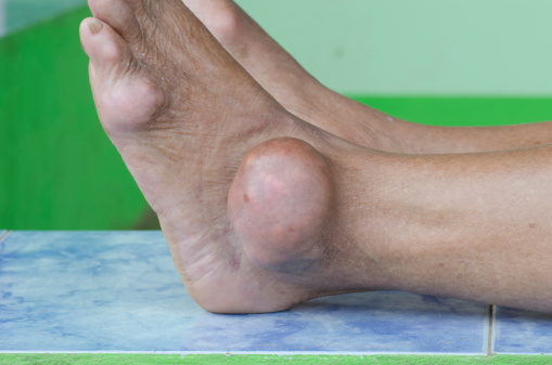 foot of gout patient