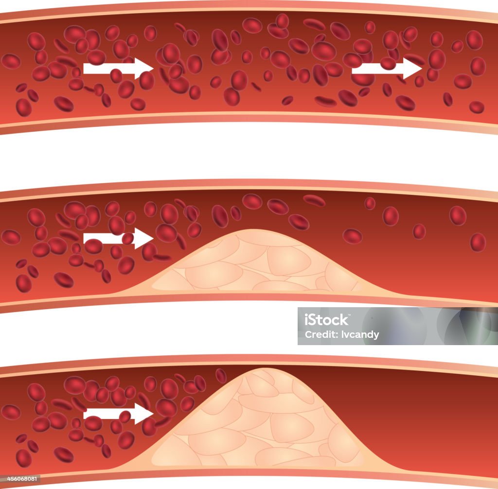 Aterosclerosis - arte vectorial de Torrente circulatorio libre de derechos