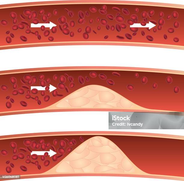 アテローム性動脈硬化 - 血流のベクターアート素材や画像を多数ご用意 - 血流, コレステロール, 拡大イメージ