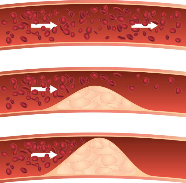 죽상동맥경화증 - blood cell anemia cell structure red blood cell stock illustrations
