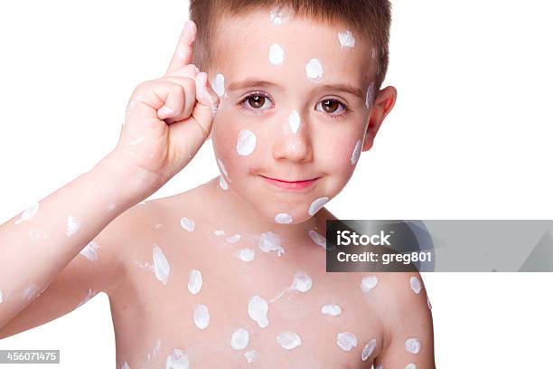 Boy With The Chickenpoxs Stock Photo - Download Image Now - Moisturizer, Sadness, The Human Body