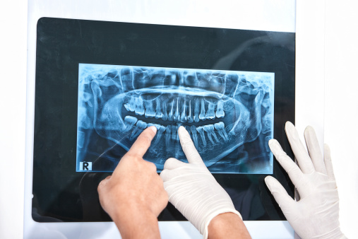 Dentist hand examining patient's teeth X Ray