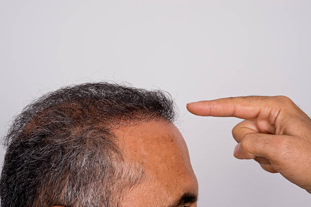 istock Six months after hair transplant surgery 456747551